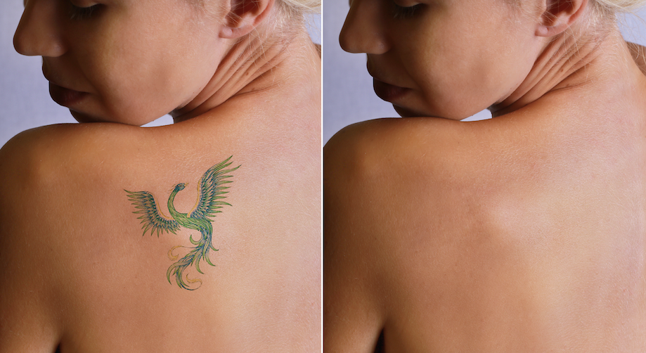 remove ugly tattoos. Laser tattoo removal is offered in york pa