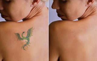 Laser Tattoo Removal is offered in York, Pennsylvania