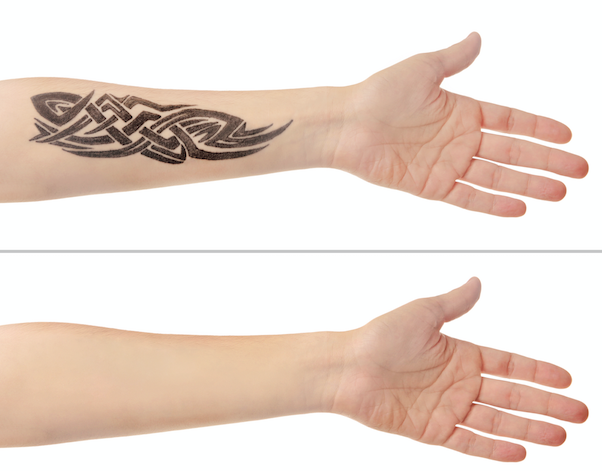 Regretting a tattoo? The York Medical spa can help