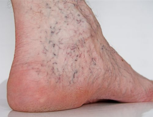 Where Do Spider Veins Come From?
