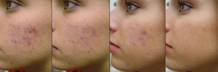 Can Lazers Clear Acne York, PA