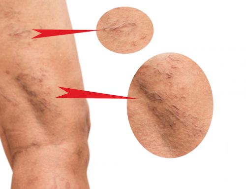 Myths About Varicose and Spider Veins